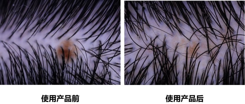 頭皮健康,紅斑,,丘疹,膿皰,評價(jià)方法