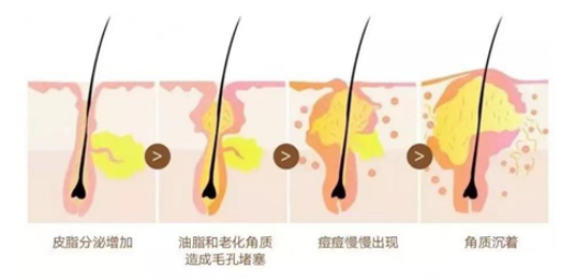 化妝品,控油評(píng)價(jià),皮脂分泌,皮膚